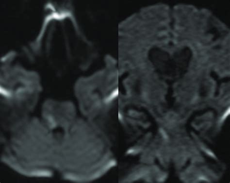Diffusion Weighted Mri Showing That An Ischemic Stroke Had Occurred In