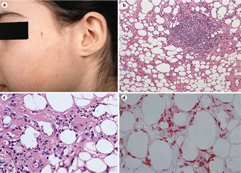 Lupus Panniculitis A A Subcutaneous Plaque On The Left Cheek B A