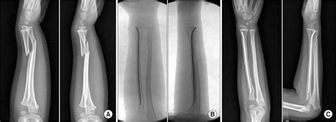 Single Bone Fixation With Flexible Intramedullary Nail For Displaced