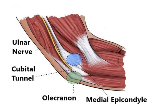Cubital Tunnel Syndrome Elbow