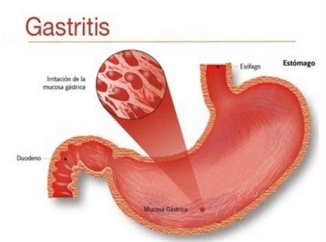 Gastritis juga bisa tingkatkan risiko kanker perut. Let's Go Public Health : Gastritis