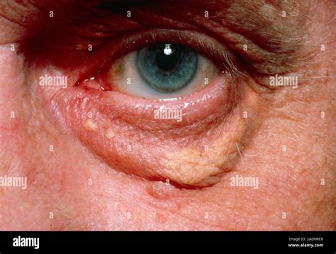 Xanthelasma A Yellowish Swelling Of The Lower Eyelid Resulting From