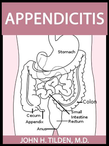 Symptoms For Appendicitis Symptoms For Ebola Virus Symptoms