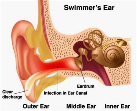 Otitis Externa Health And Medical Information