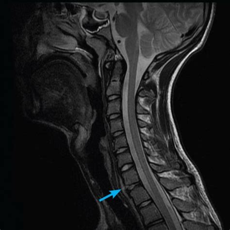 Adult Mri Series Mri Of Cervical Spine Radiculopathy