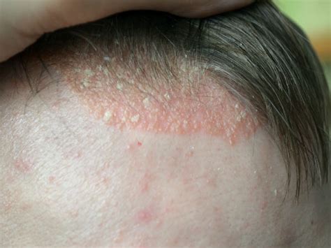 Causes And Signs Of Scalp Inflammation