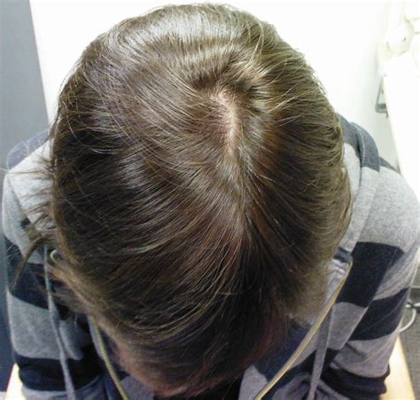 The Hair Loss Centre Female Hair Loss