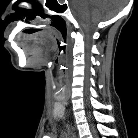 Multiplanar Ct And Mri Of Collections In The Retropharyngeal Space Is
