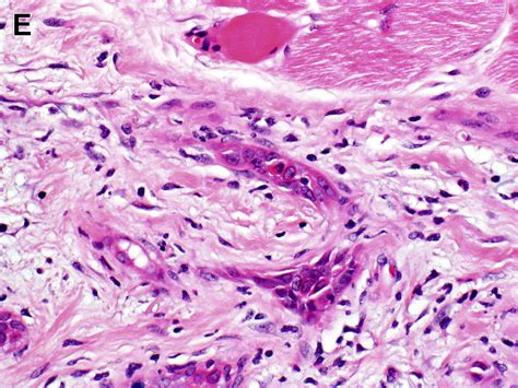 Update On Malignant Sweat Gland Tumors Surgical Pathology Clinics