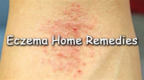 Eczema Treatment By Sachin Goyal Youtube