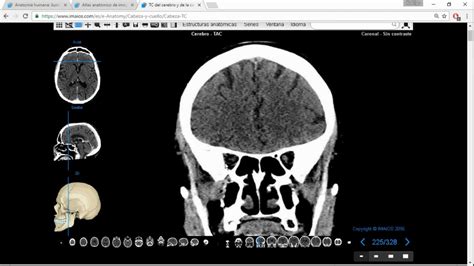 Tomografía Computada De Cabeza Para Anatomía Parte 2 Youtube