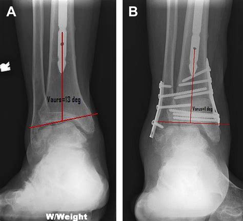 The Indications And Technique Of Supramalleolar Osteotomy Foot And