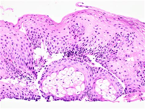 Ectopic Sebaceous Glands Blog