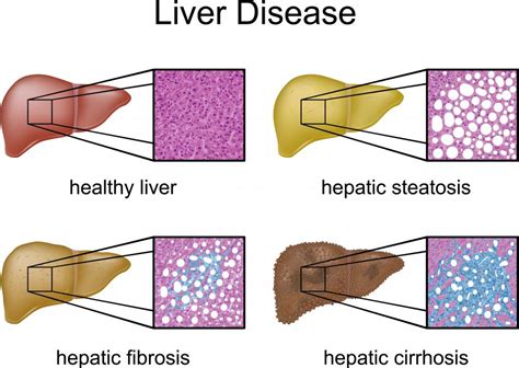 What Are The Stages Of Liver Damage With Pictures
