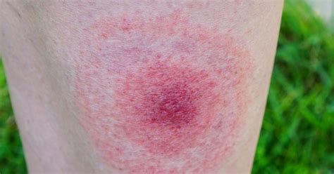 Lyme Disease Rash Symptoms Stages And Identification