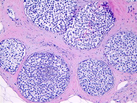 Pathology Outlines Lobular Carcinoma In Situ Lcis Classic