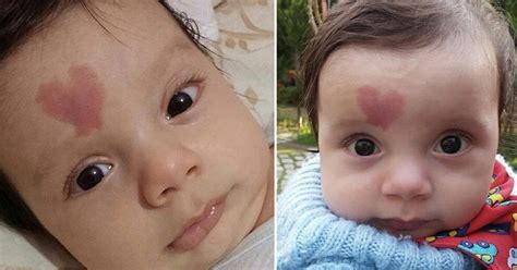 Baby Born With Heart Shaped Birthmark Became World Famous In 2015