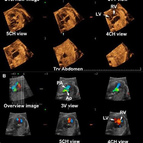 Pdf Four Dimensional Ultrasonography Of The Fetal Heart Using A Novel