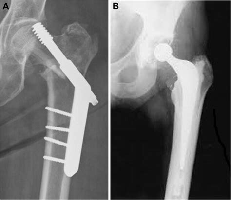 The Use Of Standard Cemented Femoral Stems In Total Hip Replacement
