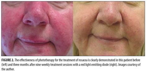 Blue Light Photodynamic Therapy For Actinic Keratosis Shelly Lighting