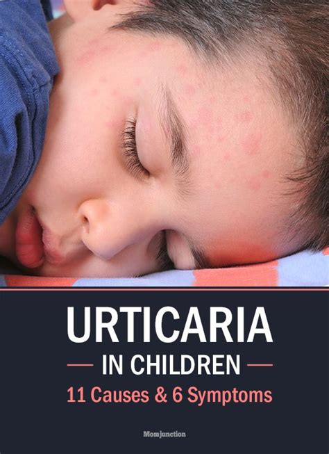 Urticaria Hives Children National University Hospital