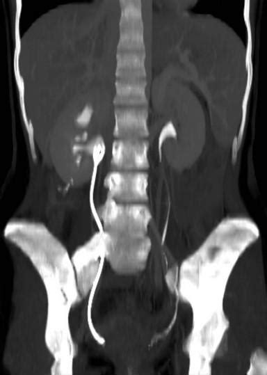 Ureteral Obstruction Complicating Crohn Disease Eurorad