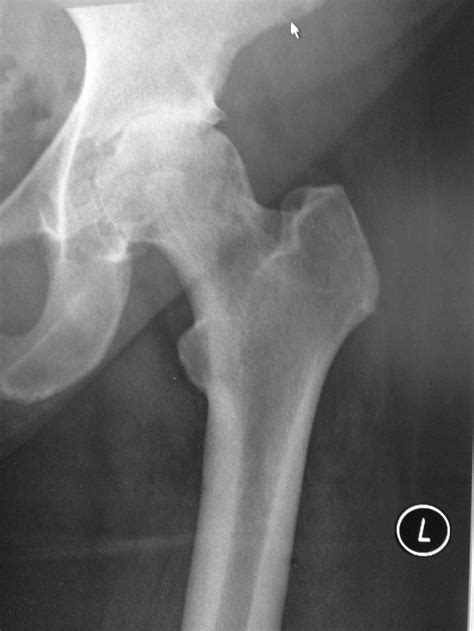 Hip Arthroscopy Knee Hip And Shoulder
