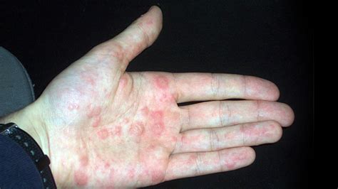 What Causes Small Bumps On Hands That Itch Allergy Trigger