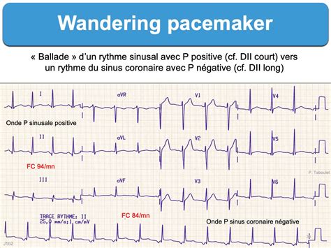 What Is A Wandering Atrial Pacemaker With Pictures