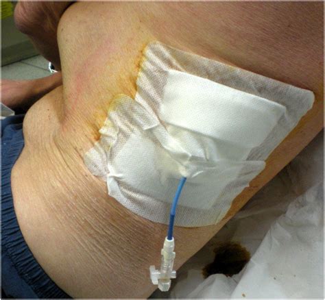 Pigtail Catheter Placement