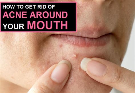 How To Get Rid Of Acne Around Mouth