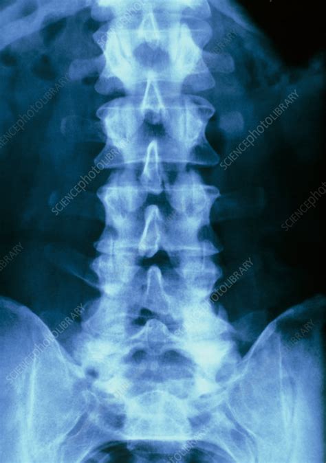X Ray Of Normal Human Lumbar Spine Lower Back Stock Image P116
