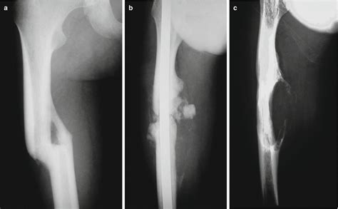 Aneurysmal Bone Cyst Musculoskeletal Key