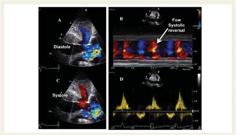 Subcostal Echocardiogram Recorded In A Patient With Severe Tricuspid