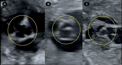 Aortic Stenosis And Bicuspid Aortic Valve Obgyn Key