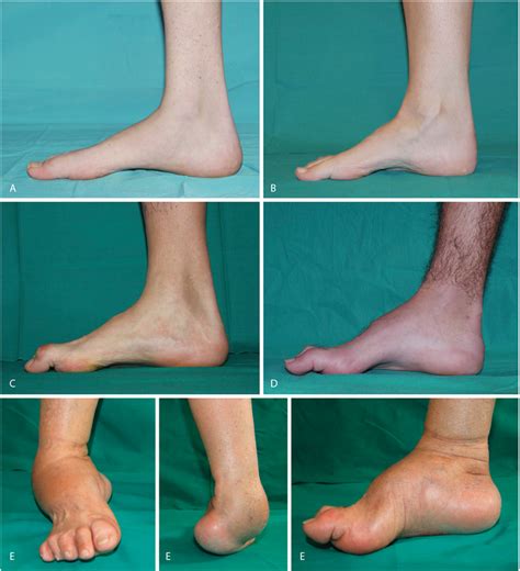 Figure 1 From Surgical Treatment Of Cavus Foot In Charcot Marie Tooth