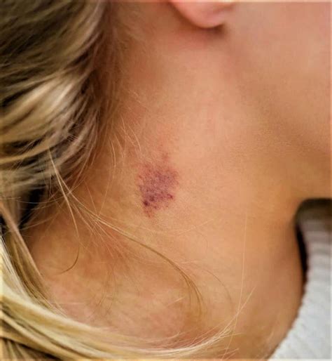 How To Get Rid Of A Hickey Quick And Easy