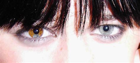 Deformutilation Heterochromia