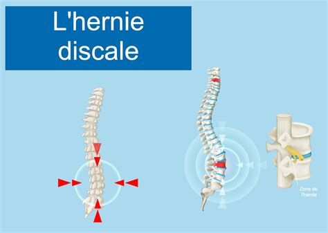 Hernie Discale Sympt Mes Et Traitements Doctissimo