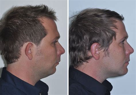 Case 14 Lower Jaw Surgery And Genioplasty Sydney Oral And Facial Surgery