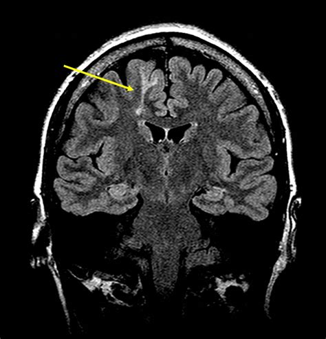 Transmantle Focal Cortical Dysplasia In A Patient With Drug Resistant