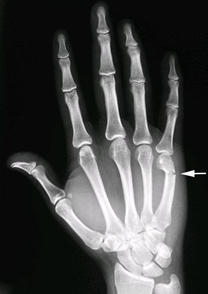 An X Ray Image Of A Hand With The Thumb Pointing Towards Its Wrist