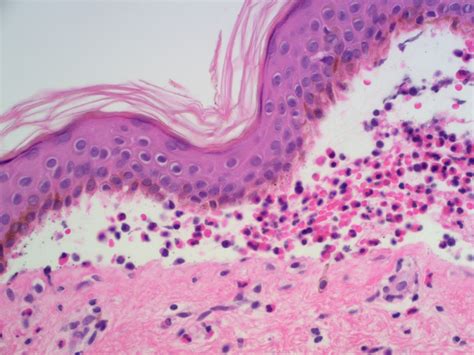 Pemphigoid Histology