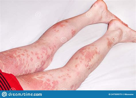 Large Red Inflamed Scaly Rash On The Stomach Acute Psoriasis On The