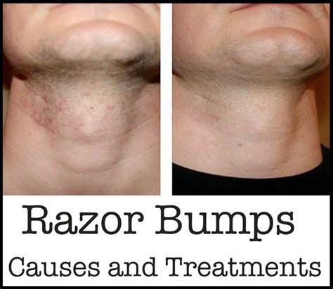 Razor Bumps Causes And Treatments Razor Burns Straight Razor