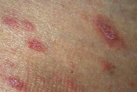 Download Pityriasis Rosea Herald Patch On Back Networkmediaget