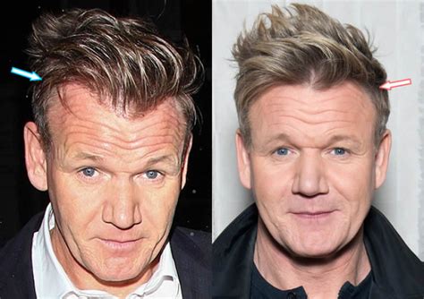 gordon ramsay before and after hair transplant