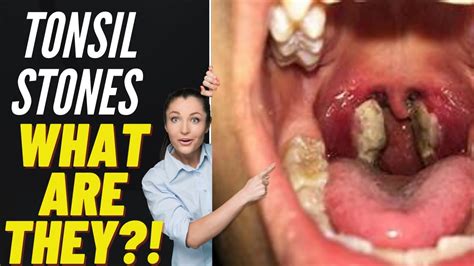 Tonsils Stone Removal Causes Treatment 2021 YouTube