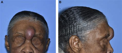 Frontal Sinus Mucopyocele Presenting As A Subcutaneous Forehead Mass