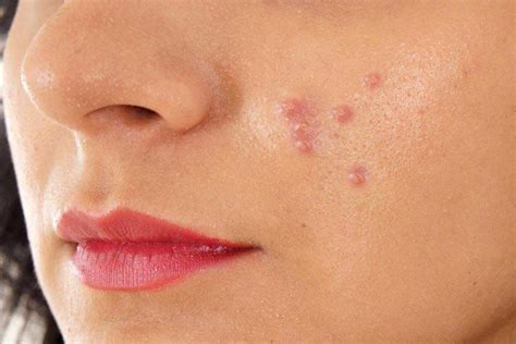 Different Types Of Acne On The Face And How To Treat Them Personal